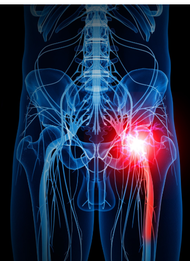 Sciatica Again! – BionicOldGuy